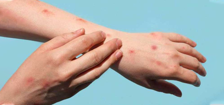 Fourth Mpox Case Reported in KP